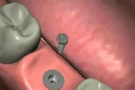 揭秘牙齒矯正的全過程!!!