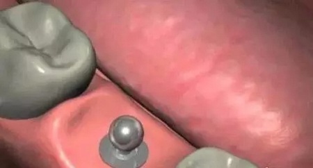 揭秘牙齒矯正的全過程!!!