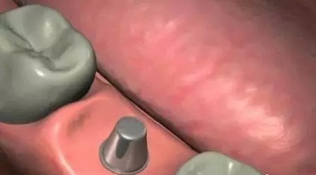 揭秘牙齒矯正的全過程!!!