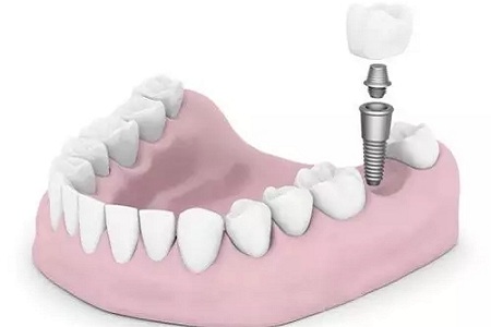 揭秘牙齒矯正的全過程!!!