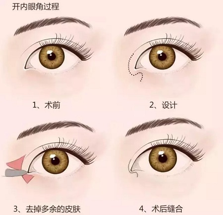 美萊實驗室:開眼角就是醫師想多收錢?