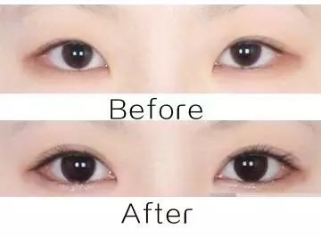 美萊實驗室:開眼角就是醫師想多收錢?