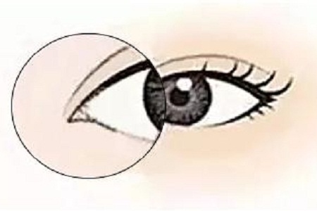 美萊實驗室:開眼角就是醫師想多收錢?