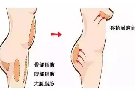 問診室:你說脂肪壓得你好累,殊不知它也可以是寶貝