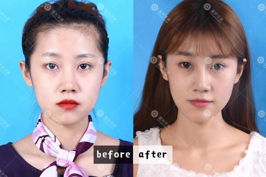 進(jìn)口和國產(chǎn)瘦臉針有什么區(qū)別？2分鐘看懂