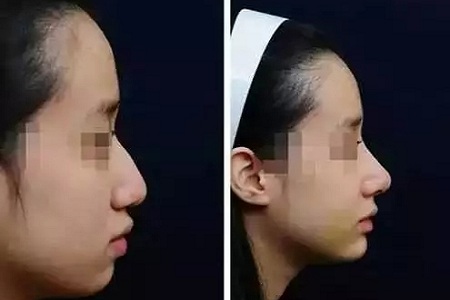 噓!你想不想隨心所欲的美?選擇玻尿酸吧!