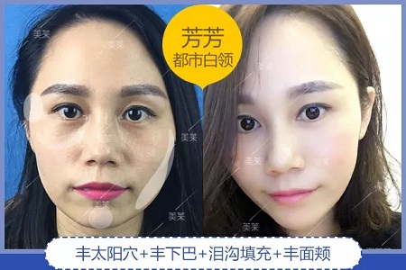 噓!你想不想隨心所欲的美?選擇玻尿酸吧!