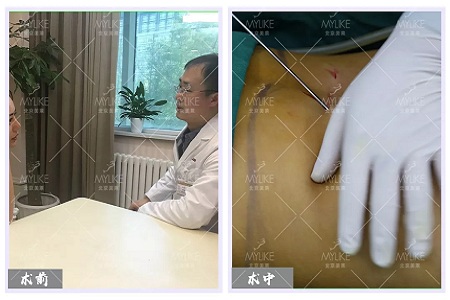 顏值:媽寶“水桶腰”變“水蛇腰”的方法--吸脂