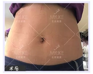 顏值:媽寶“水桶腰”變“水蛇腰”的方法--吸脂