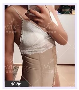 顏值:媽寶“水桶腰”變“水蛇腰”的方法--吸脂