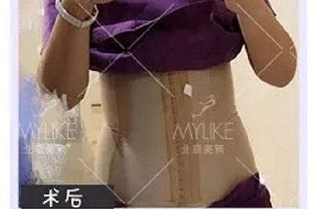 顏值:媽寶“水桶腰”變“水蛇腰”的方法--吸脂