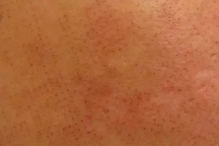 粗糙、毛孔粗大、起皮......換季肌膚問(wèn)題如何解決?