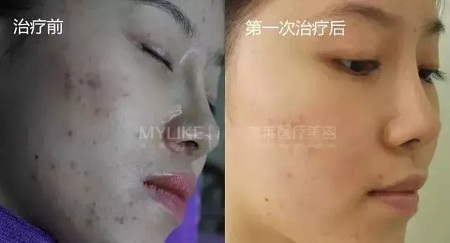 愛長痘痘的你,應該試試這道光!