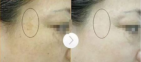 超皮秒激光祛斑，實力素顏，不加“斑”