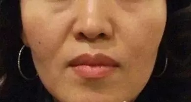 用玻尿酸治療鼻唇溝,一定要注意這種情況!