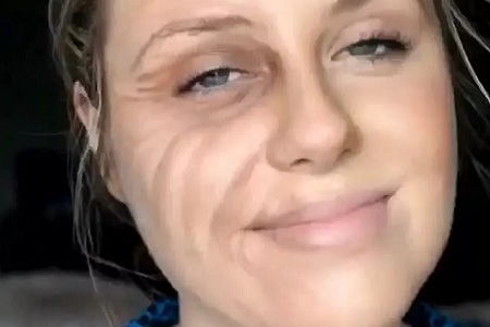 用玻尿酸治療鼻唇溝,一定要注意這種情況!