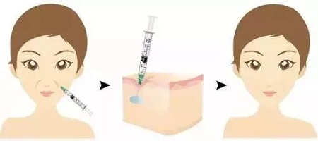 用玻尿酸治療鼻唇溝,一定要注意這種情況!