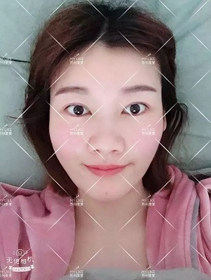 面部填充會不會把臉填大?