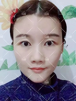 面部填充會不會把臉填大?