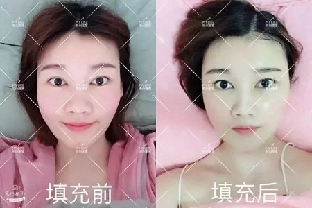 面部填充會不會把臉填大?