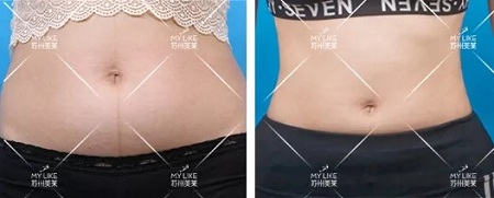 夏天到了，你想過吸脂讓自己瘦下來嗎？