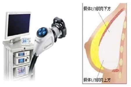 隆胸時醫師怎樣把直徑10cm的假體，塞入3cm的切口中的？