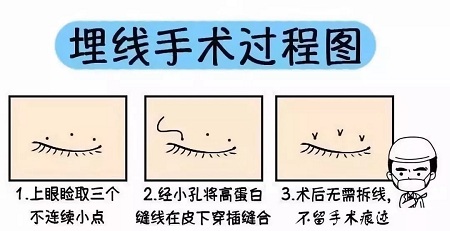 美眼張誠坐診美萊,淺談為什么你的眼睛不夠美?