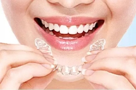 美萊隱形矯正,你笑起來的樣子特別美!
