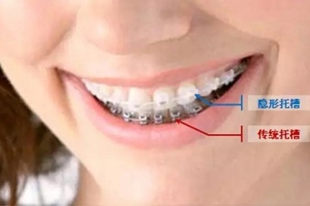 美萊隱形矯正,你笑起來的樣子特別美!