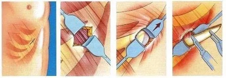 想知道身邊人有沒有做過隆鼻?看完這篇文章你就知道了