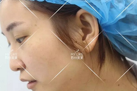 鼻子不是越高越好看!