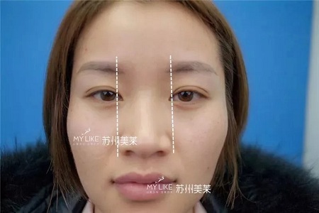 鼻子不是越高越好看!