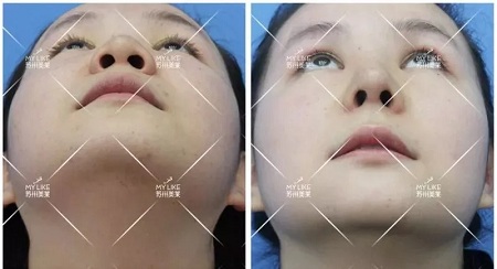 鼻子不是越高越好看!