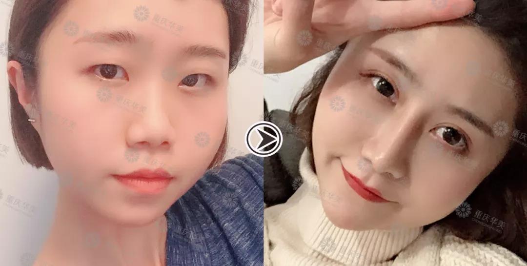 雙眼皮手術(shù)前后對比