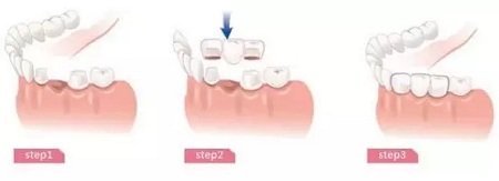 牙齒缺失時，選烤瓷牙還是那種？