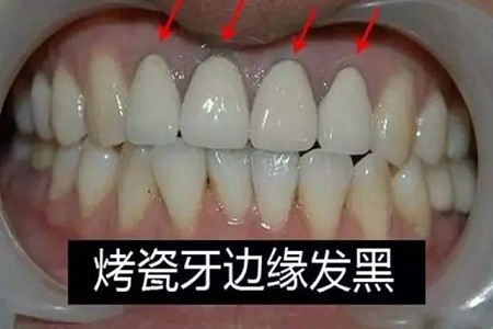 牙齒缺失時，選烤瓷牙還是那種？