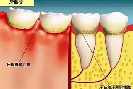 牙齒缺失時，選烤瓷牙還是那種？