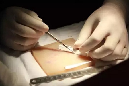 假體隆鼻的“高度”主要決定于哪些因素？