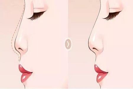 做鼻子可以不用假體嗎?