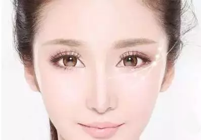 昆明做雙眼皮手術(shù)需要多少錢(qián)