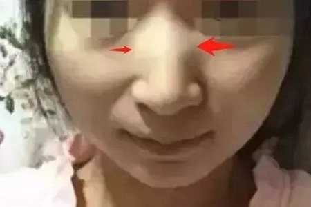 側面看鼻梁不矮,正面看鼻子卻很塌是什么原因?