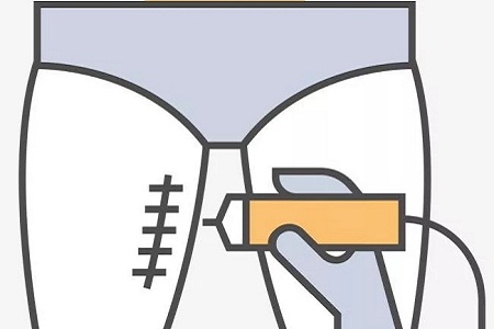 吸脂=減肥？這些常見的吸脂誤區你經歷過嗎？