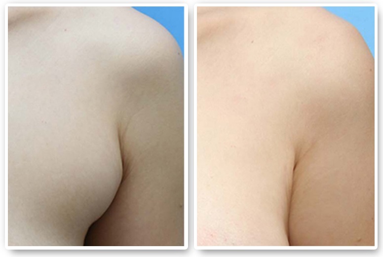 副乳手術(shù)一般多少錢(qián)