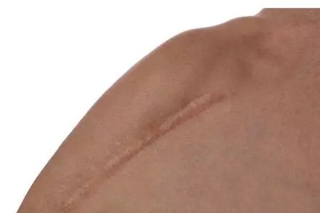 疤痕體質不能做整形項目了嗎?