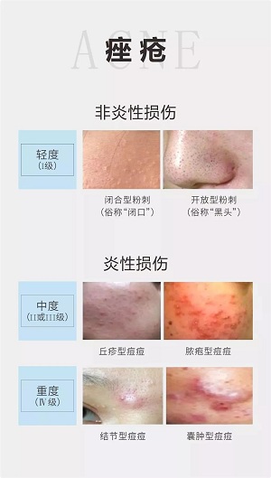 痤瘡分為粉刺和毛囊炎兩大類，按輕重程度分成四個等級