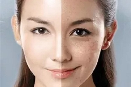 出現色素沉著代表祛斑治療失敗嗎?