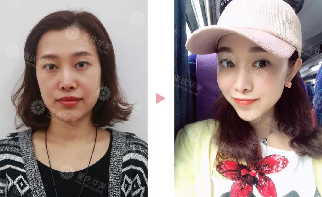 線雕做了一年后，臉會不會比以前垮？