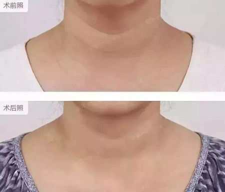 平復頸紋，延緩衰老