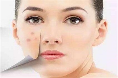 祛黃褐斑多少錢