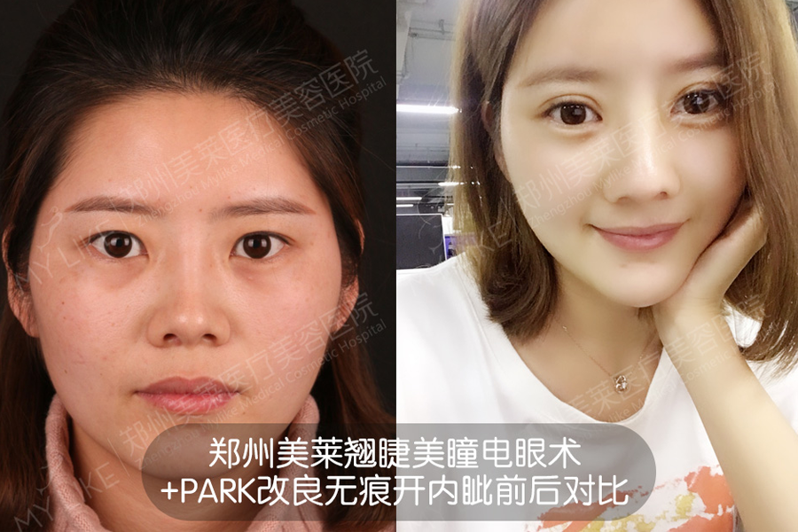 雙眼皮全切好還是埋線好?<a href='/zz/' target='_blank'><u>鄭州美萊</u></a>割雙眼皮哪位醫生好?